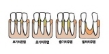 심각한 잇몸병, 임플란트 치료 부른다