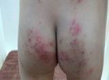 영양 불균형이 아토피치유 장애 원인으로 밝혀져
