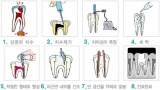 말기 충치, 신경치료로 치아 살린다