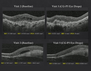 케어젠 CG-P5, 습성 황반변성 1상서 안전성·유효성 신호 확인