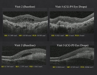 케어젠 CG-P5, 습성 황반변성 1상서 안전성·유효성 신호 확인